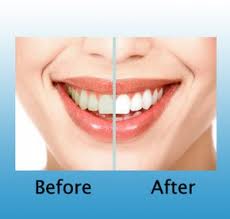 Post Operative Splints Surgery saravana dental clinic thiruthuraipoondi and vedaranyam